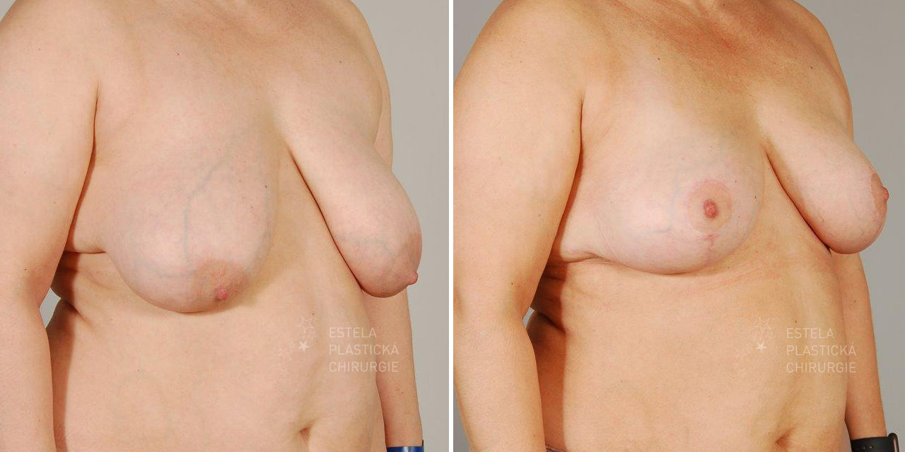 modelace prsou před a po